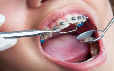 Straighten Teeth Discreetly Using Clear Braces, Fort Lauderdale, FL Dental Experts Recommend