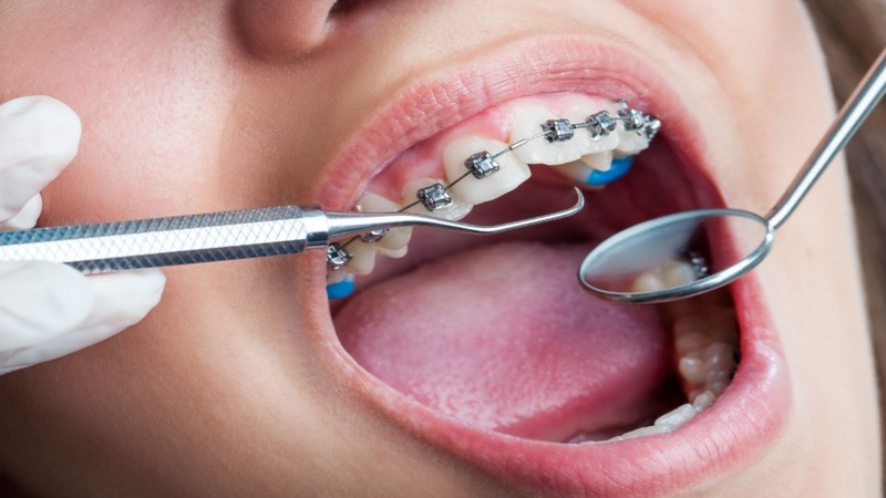 Straighten Teeth Discreetly Using Clear Braces, Fort Lauderdale, FL Dental Experts Recommend