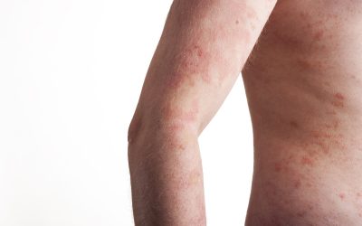 Gain Peace of Mind by Understanding Your Reactions With Allergy Testing in Arlington TX